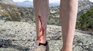 A backcountry enthusiast with blood on their leg standing on top of a mountain.